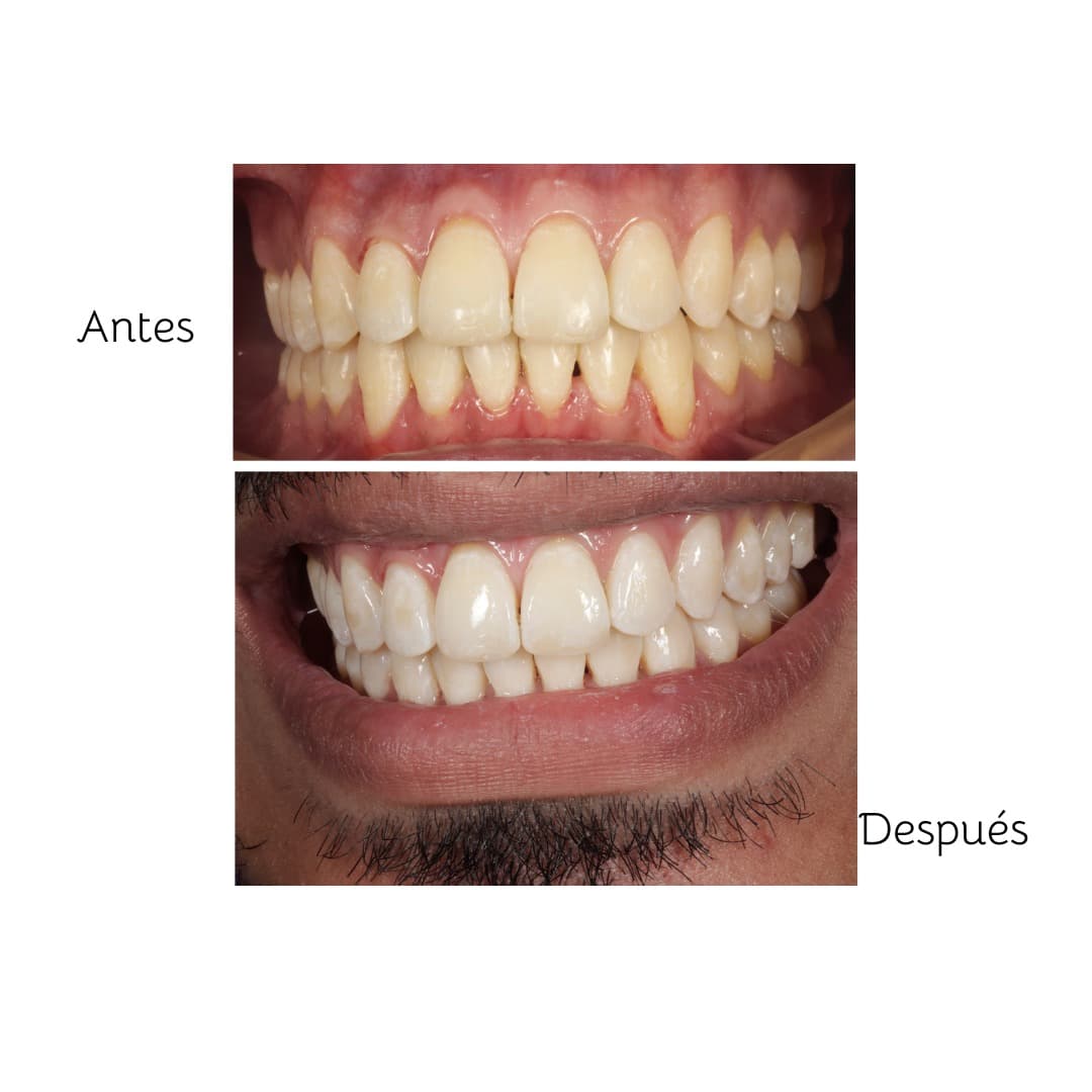 Blanqueamiento Dental