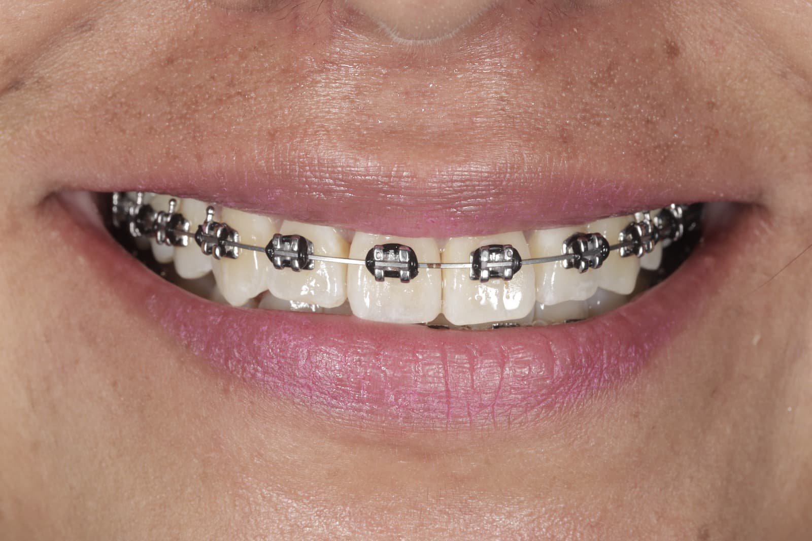 Ortodoncia Especializada